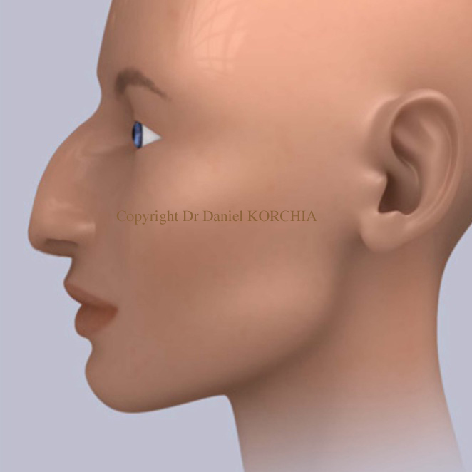 rhinoplastie bosse du nez