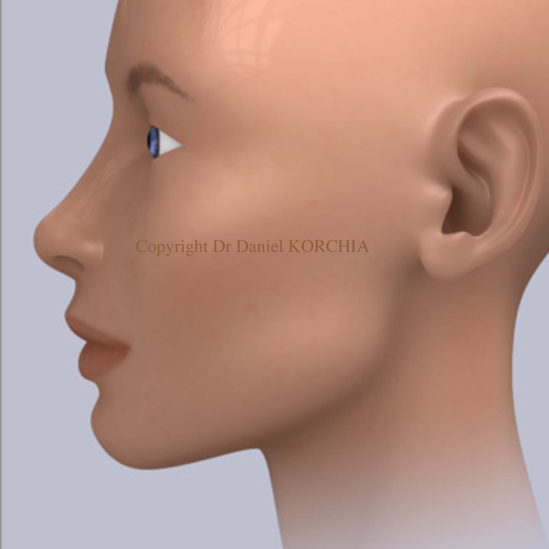 Rhinoplastie pointe du nez tombante