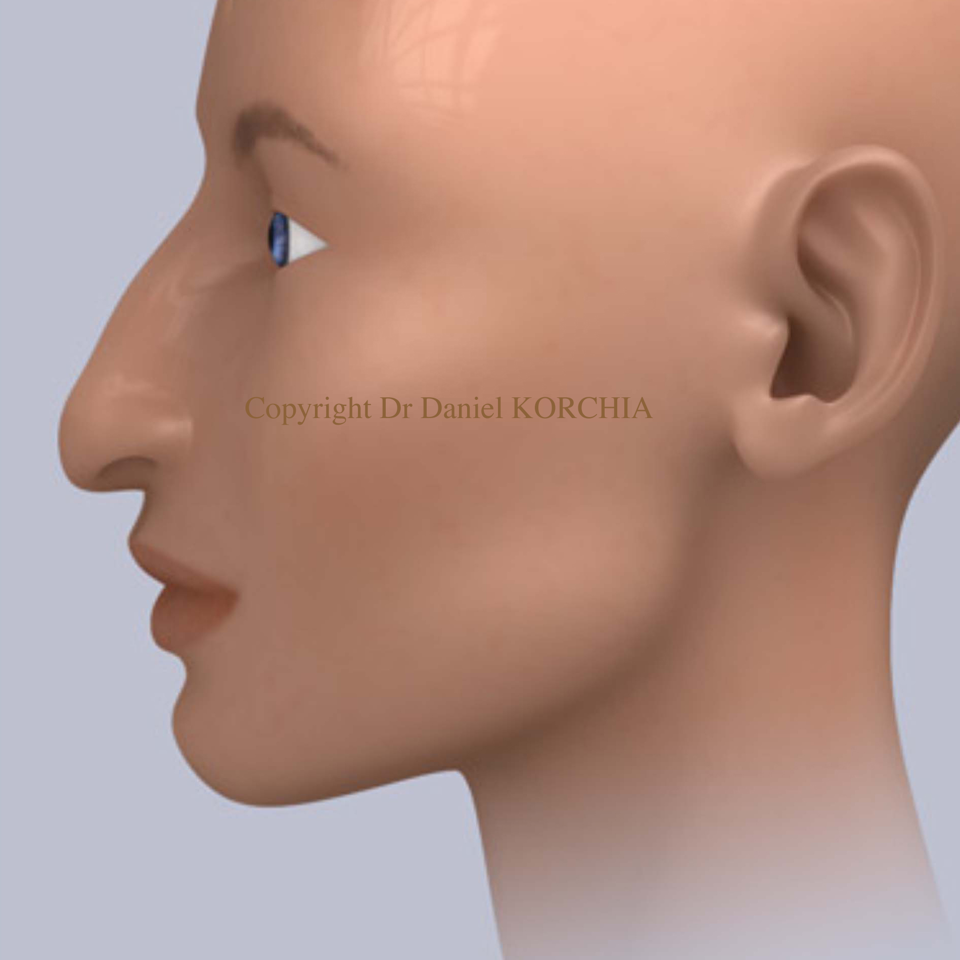 Rhinoplastie pointe du nez tombante