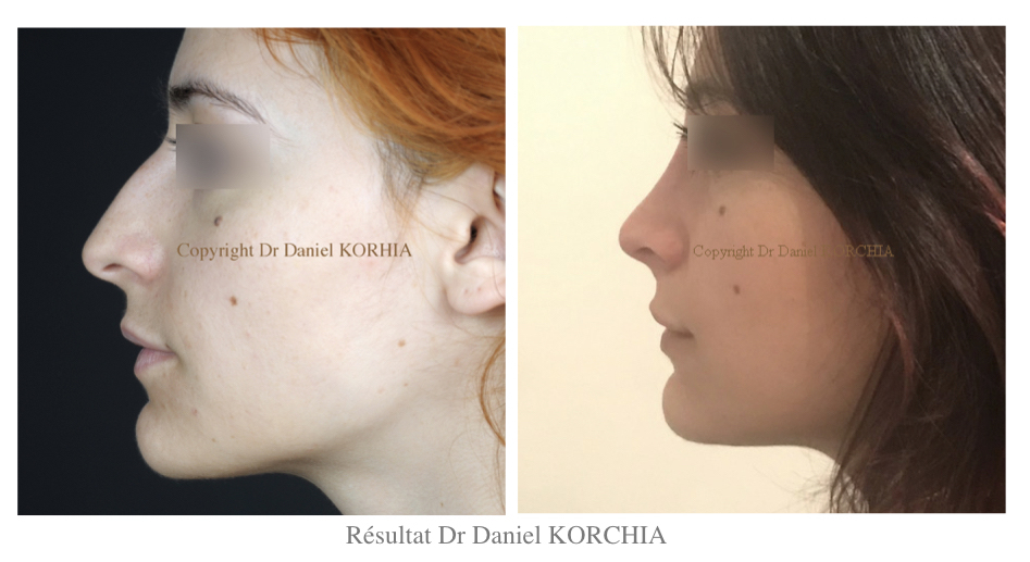 rhinoplastie meilleure marseille