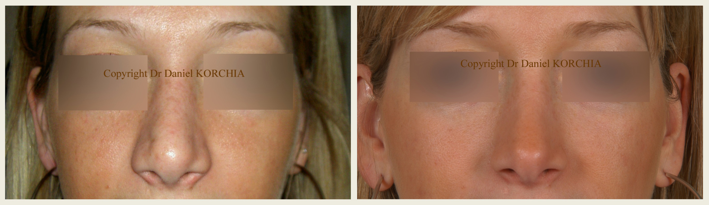 chirurgie rhinoplastie resultats
