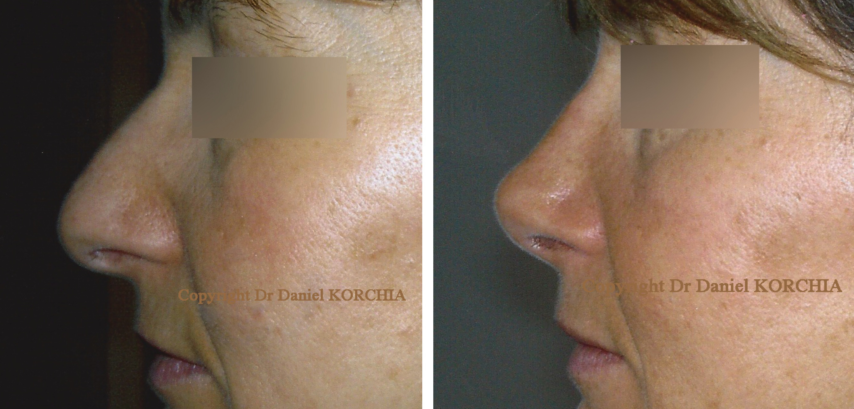 rajeunissement du visage