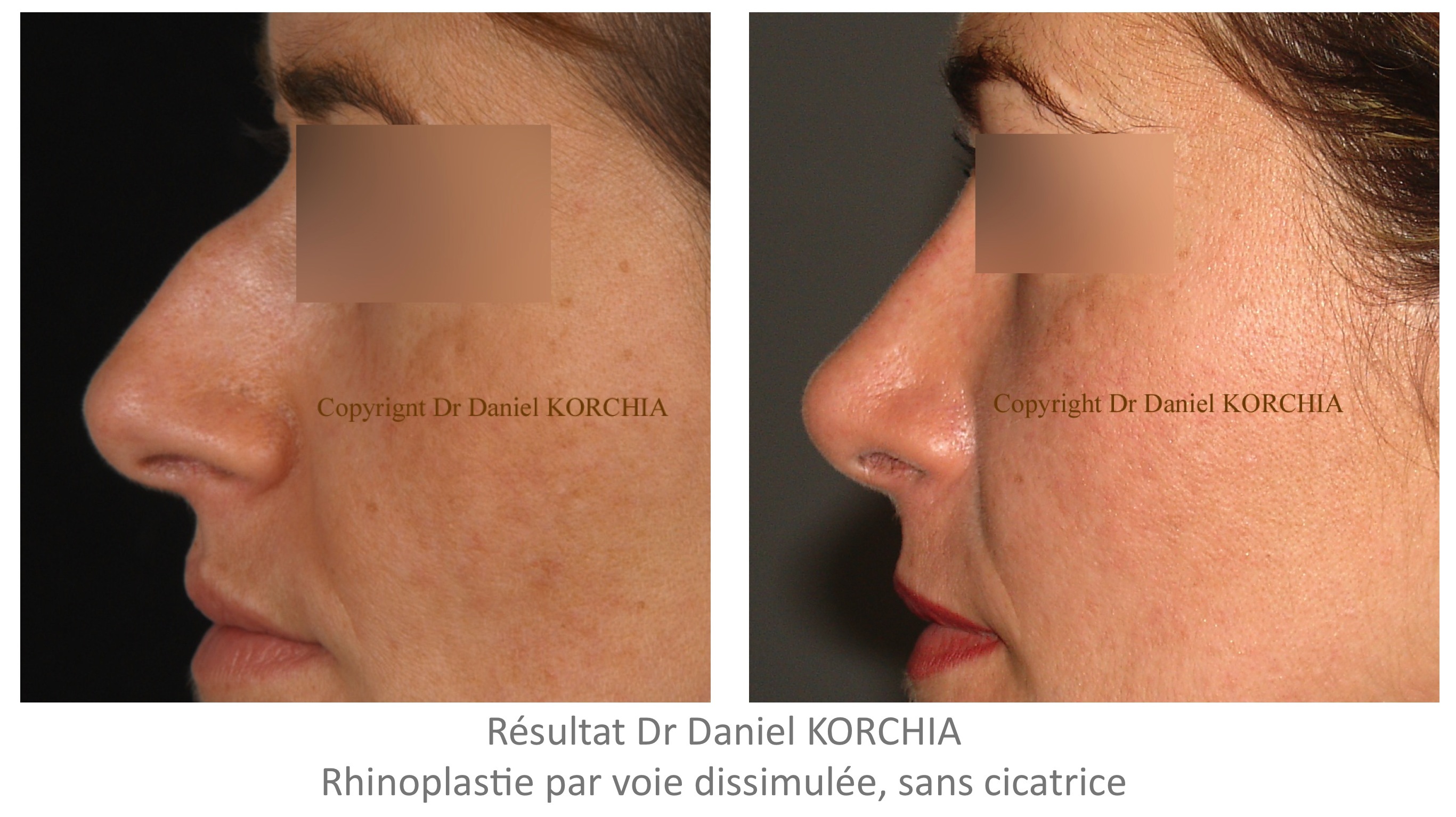 Rhinoplastie sans cicatrice ou voie dissimulée