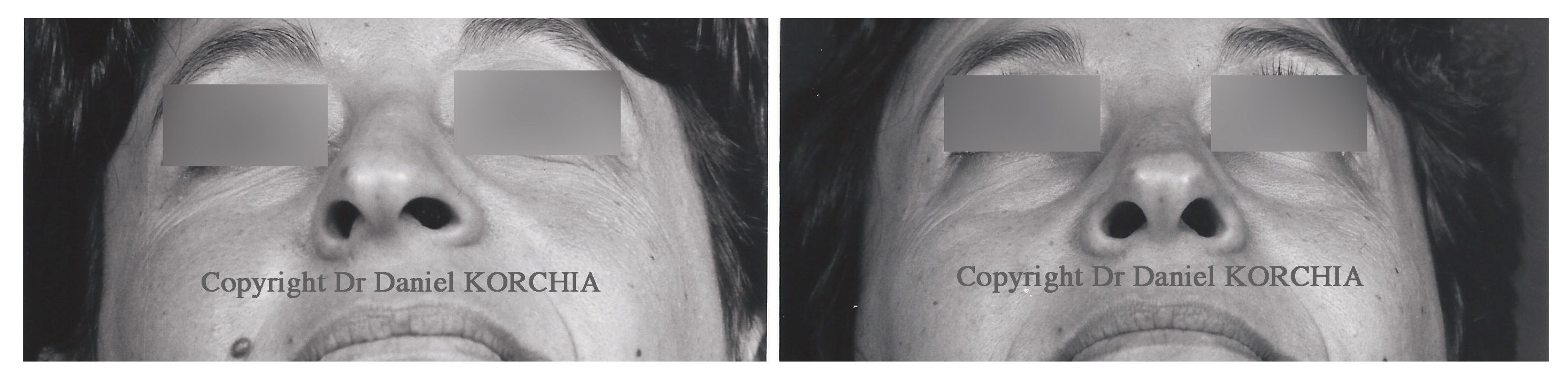 rhinoplastie deviation nasale