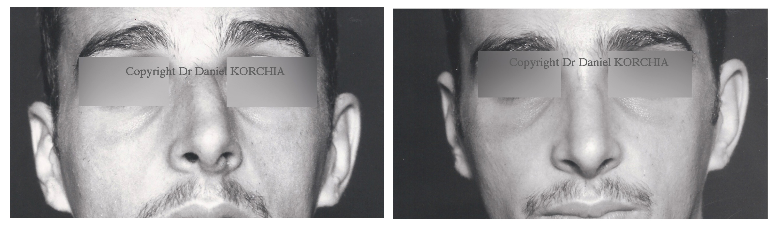 rhinoplastie deviation du nez